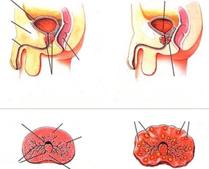 normal Prostata a chronische Prostatitis