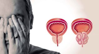 Gesond a entzündegt Prostata