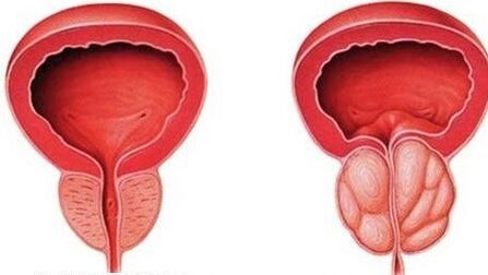 normal an entzündete Prostata
