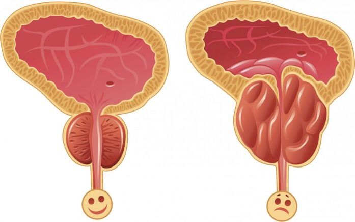 gesond an entzündete Prostata mat Prostatitis
