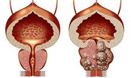 Gesunde an ungesunde Prostata