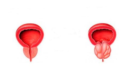 gesond an entzündegt Prostata mat Prostatitis