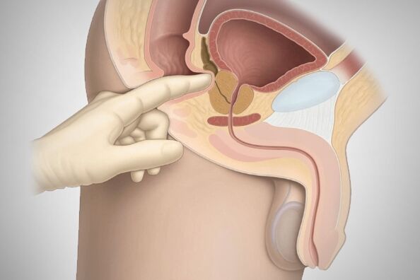 Prostatamassage fir bakteriell Prostatitis