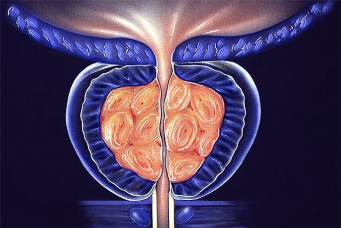 Symptomer a Behandlung vu Prostatitis
