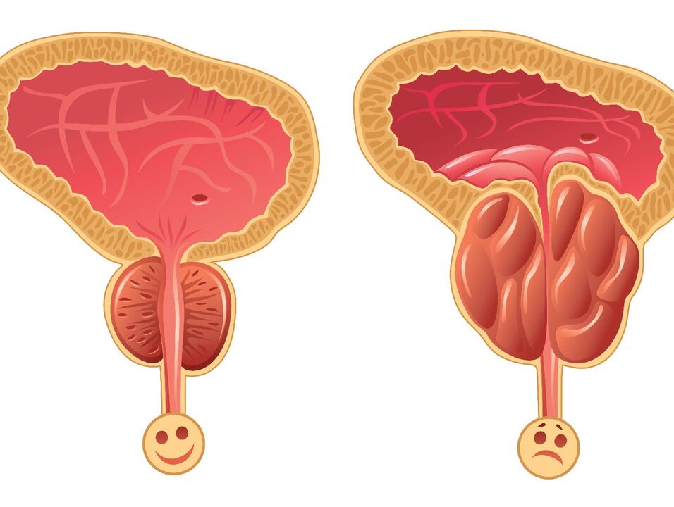Gesond Prostata Drüs a Prostata Stau mat congestive Prostatitis