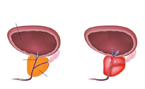 normal an entzündegt Prostata