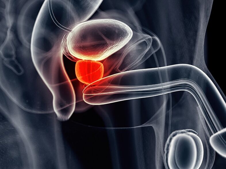 Entzündung vun der Prostata drüs begleet chronescher Prostatitis