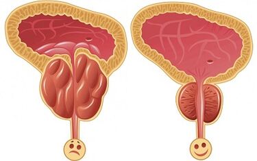 wéi Prostalix funktionnéiert fir Prostatitis virun an no der Behandlung